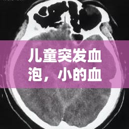 兒童突發(fā)血泡，小的血泡 