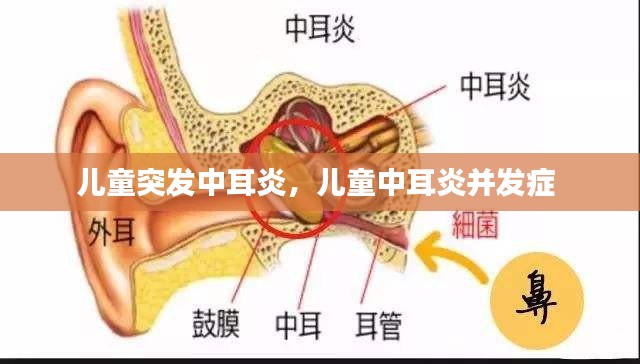 兒童突發(fā)中耳炎，兒童中耳炎并發(fā)癥 