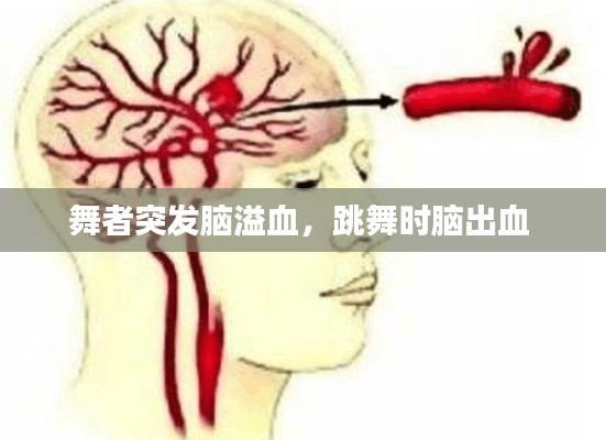 舞者突發(fā)腦溢血，跳舞時腦出血 